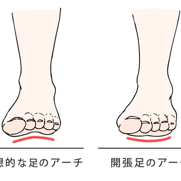 【理学療法士監修】開張足は矯正できる？ 開張足のためのインソールや靴選び